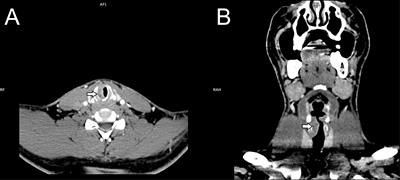 Small cell carcinoma with neuroendocrine differentiation of subglottic larynx- a case report